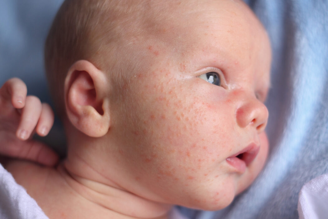 Newborn Baby Acne | Treatment and Causes