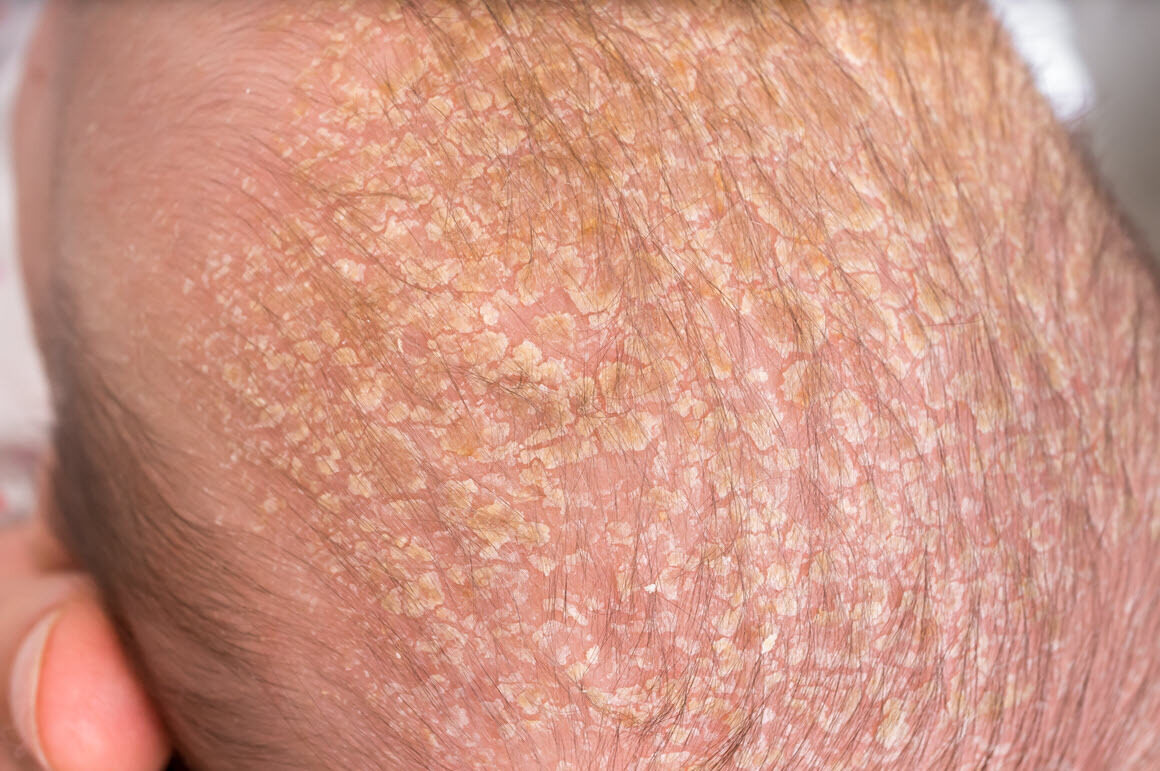 Why Does My Baby Have Cradle Cap? Causes, Symptoms and Gentle Care Tips
