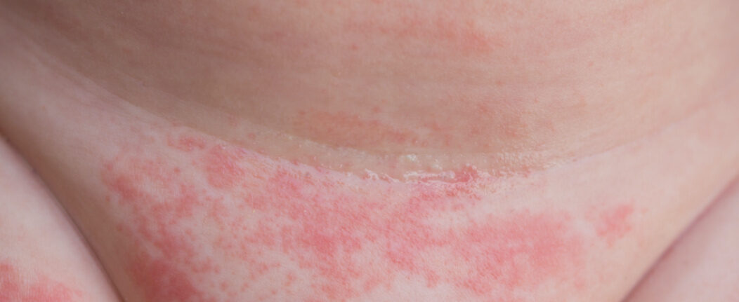 Newborn Baby Milk Spots