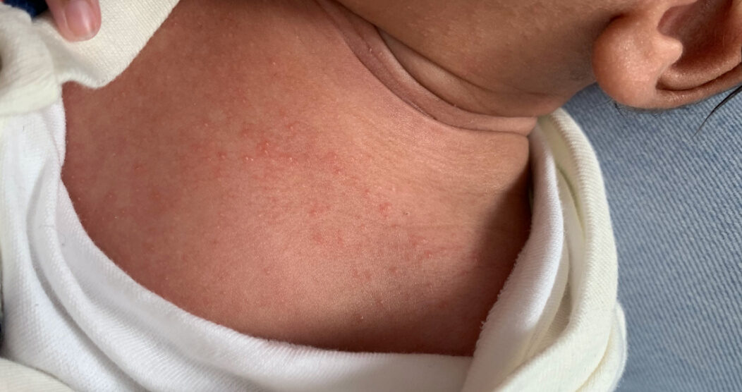 Newborn Baby Milk Spots - Milia