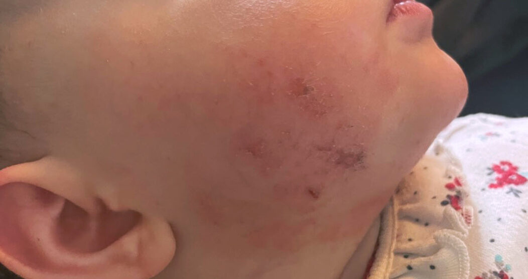 SOS : Comment soigner les griffures au visage de bébé.